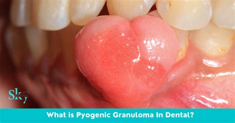 Pyogenic Granuloma in Dental - SKY Dental Vijayawada