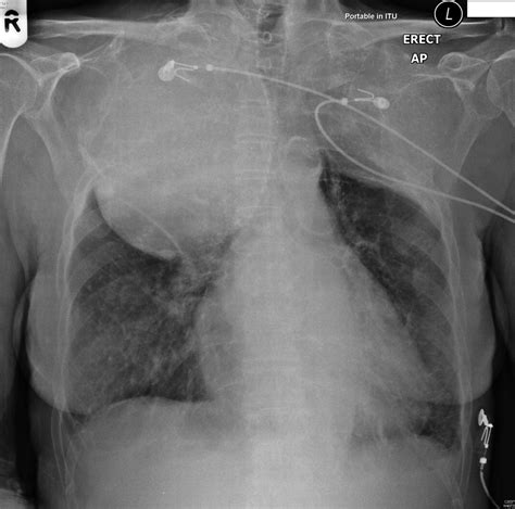 Tracheal compression: a late complication of plombage | BMJ Case Reports