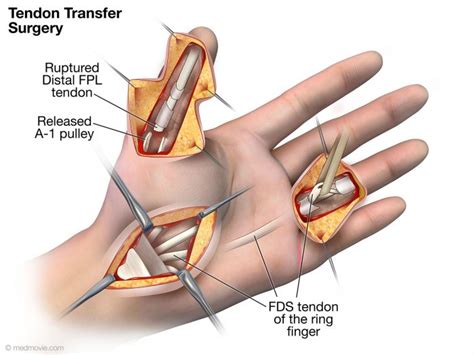 Flexor Pollicis Longus Tendon