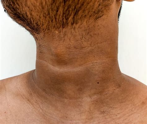 Acanthosis nigricans — Medical Secrets