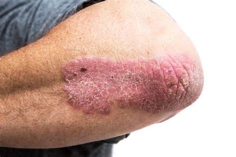 Psoriasis and cancer: What’s the link? - Harvard Health