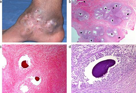 A case of eumycetoma showing (a) a large plaque with atrophic surface ...