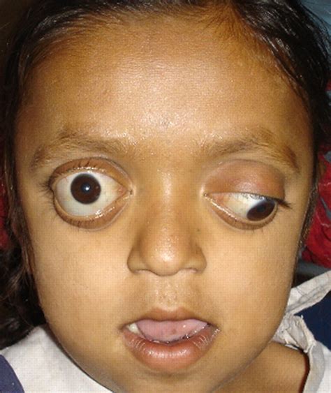 Crouzon syndrome | BMJ Case Reports