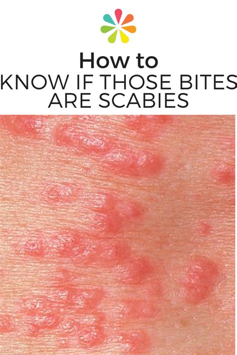 90 Amazing Can You See Scabies Mites On Skin - insectza