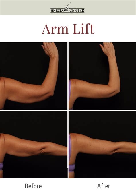 Achieve Beautiful Arms with Arm Lift Surgery