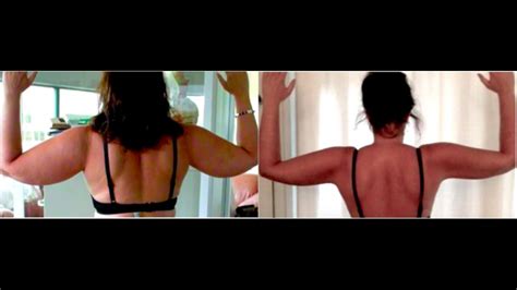 SEE HOW I WAS ABLE TO SCULPT MY FEMALE LIPEDEMA ARM WITH AWAKE ...