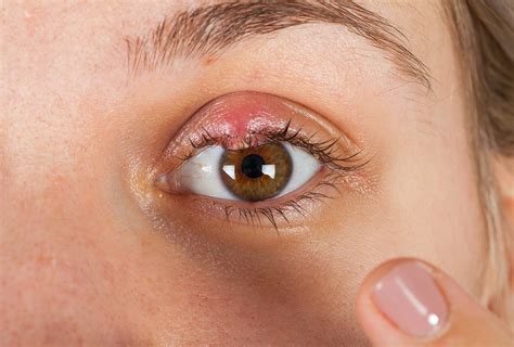 8 Home Remedies to Get Rid of Eye Stye - eMediHealth