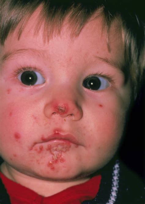 Image: Impetigo em uma criança - Manual MSD Versão Saúde para a Família