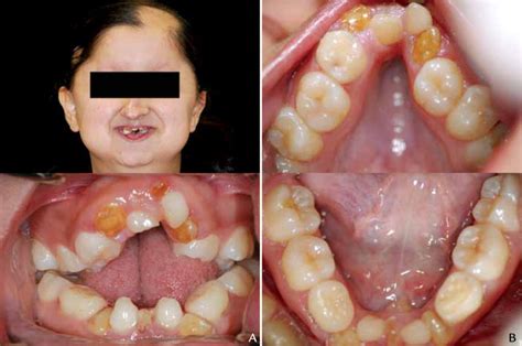 Hallermann-Streiff syndrome patient treated with removable prosthesis ...