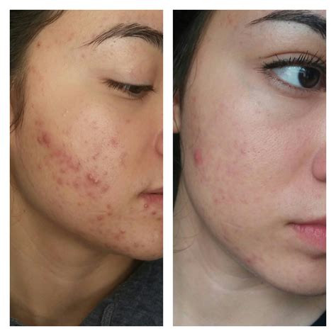 My Experience with Tazorac so far – Personal logs – Acne.org Forum