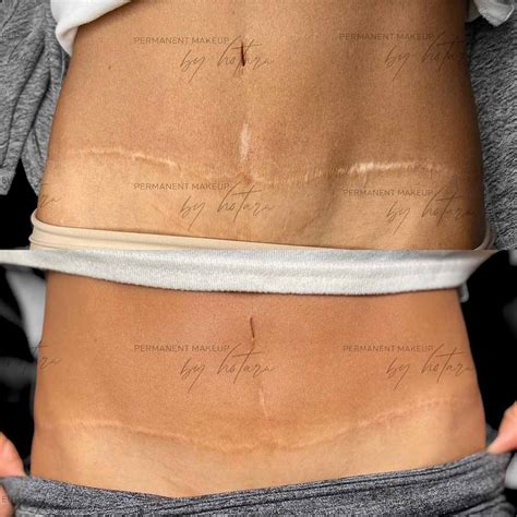 Tummy Tuck Scar Camouflage - Most Popular Treatments