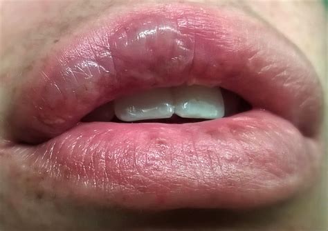 water blister on lips - pictures, photos