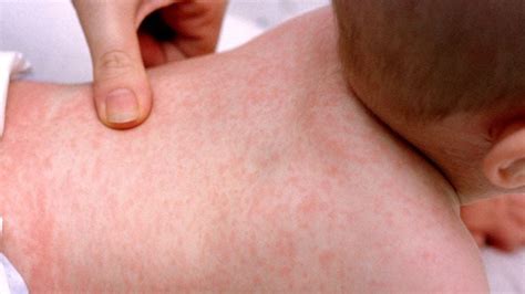 10 common rashes on kids (with photos) - Today's Parent