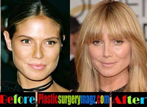 Heidi Klum Plastic Surgery Before and After | Heidi klum, Plastic surgery, Celebrity plastic surgery