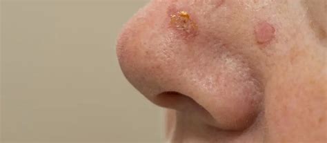 Cryosurgery For Common Skin Lesions | Healthtian