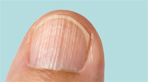 How to Fix Nail Ridges and the Causes Behind Them – Daline Nails