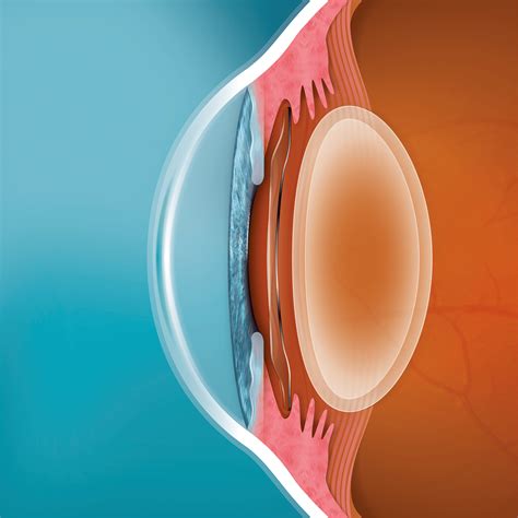 EVO ICL Eye Surgery | EVO Implantable Collamer Lens