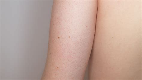 Keratosis Pilaris: Diagnosis, Causes, & Treatment - Toronto Dermatology Centre