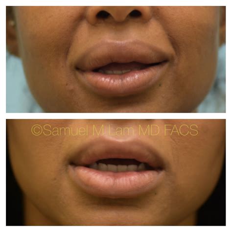 This African-American woman is shown before and 5 months after upper and lower lip reduction to ...