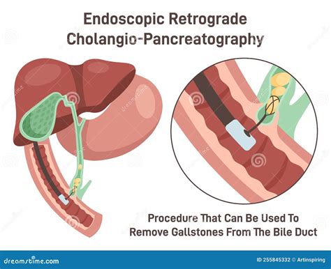 Endoscopic Retrograde Cholangiopancreatography. ERCP, Bile Duct Diagnosis. Vector Illustration ...