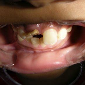 (PDF) CLINICAL CONSIDERATIONS FOR THE ENDODONTIC TREATMENT OF DILACERATED TOOTH: A CASE REPORT