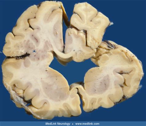 Schizencephaly | MedLink Neurology