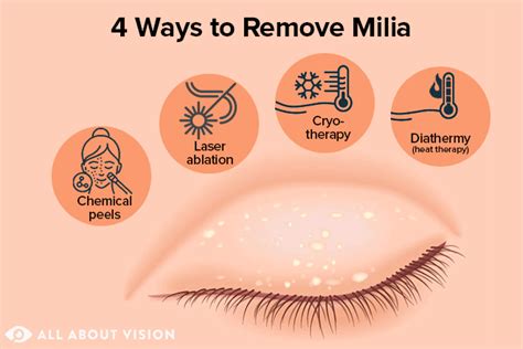 Eyelid Bumps 101: How To Identify Styes, Milia Pimples Allure | peacecommission.kdsg.gov.ng