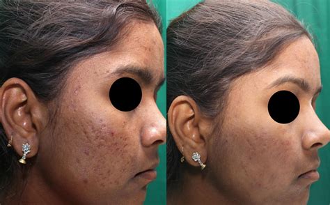 Professional Microneedling acne scars Treatment in Brisbane