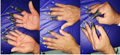 Cureus | Severe Frostbite Due to Extreme Altitude Climbing in South America: A Case Report