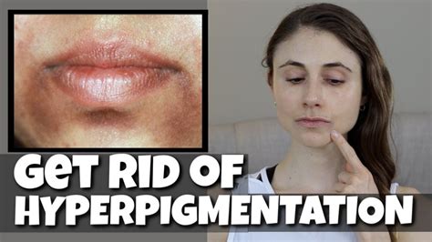 GET RID OF HYPERPIGMENTATION AROUND THE MOUTH| DR DRAY ...