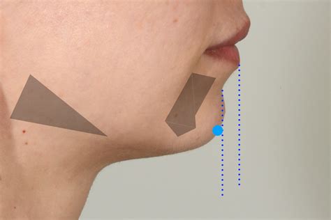 Chin Implants |Enhance Your Facial Proportion | Charleston, SC