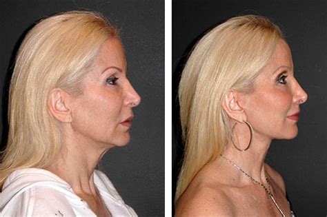 Facelift Scarring How To Avoid Facelift Scars No Facelift Scars | My XXX Hot Girl