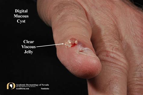 Digital Mucous Cyst (DMC): Myxoid Cyst... - Academic Dermatology of Nevada