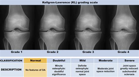 The KL grading system to assess the severity of knee OA. | Download Scientific Diagram