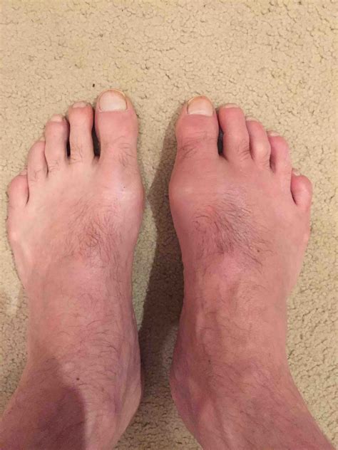 What does gout on feet look like? - powerpointban.web.fc2.com