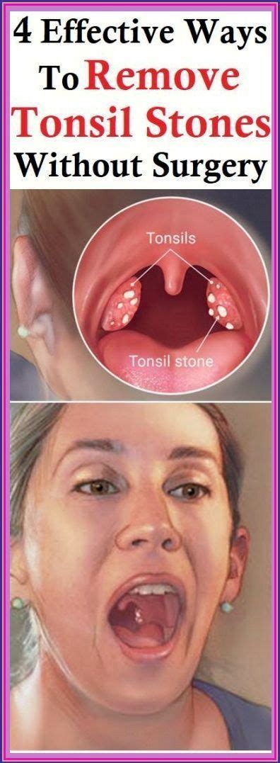 4 Effective Ways To Remove Tonsil Stones Without Surgery Nails, Health Tips, Homemade Facials ...