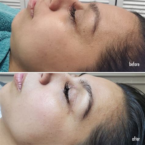 dermaplane-before-and-after-2 - Dérmica MedEsthetics