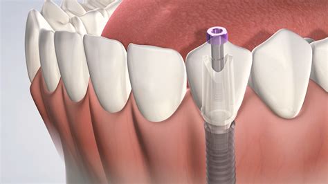 Why Switch From Dentures To Dental Implants? - The Appliance of Kenmccrimmon