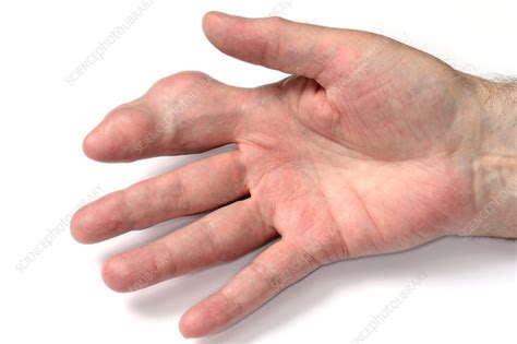 Gout in the finger - Stock Image - C014/2459 - Science Photo Library