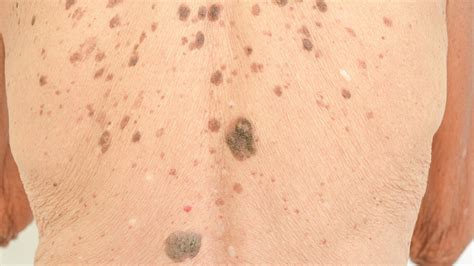 Liver Disease Spots On Skin