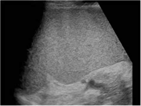 Abdomen and retroperitoneum | 1.4 Spleen : Case 1.4.3 Splenic infarcts | Ultrasound Cases