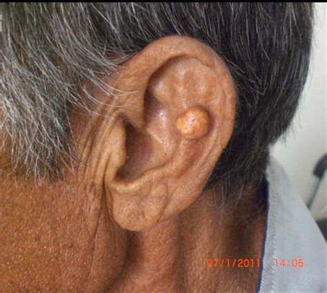 Phimaimedicine: 979. Tophi of ear