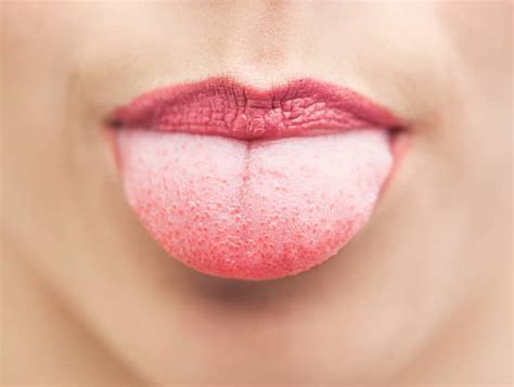 Coated or white tongue - Healthily