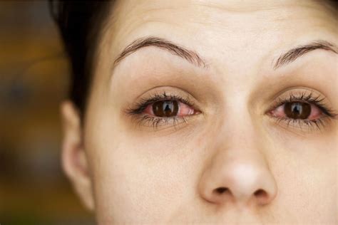 Red Eyes: Causes, Complications, and How to Treat | MyVision.org