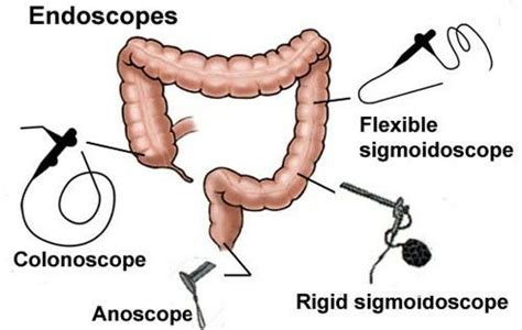 Extent of Lower GI scopes ... [ Note : Rigid Sigmoidoscope - 25 cm, Flexible Sigmoidoscope - 60 ...