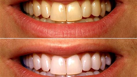 Teeth Whitening Dentist Before After - White Choices