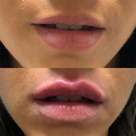 diy lip filler injections - Iesha Seitz