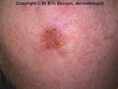 stage 4 squamous cell carcinoma life expectancy without treatment