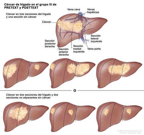 Tratamiento del cáncer de hígado infantil (PDQ®)