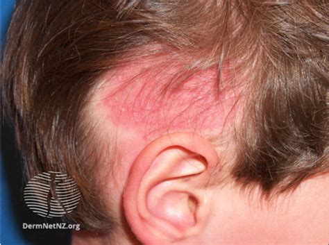 Tinea capitis (scalp ringworm) - HSE.ie